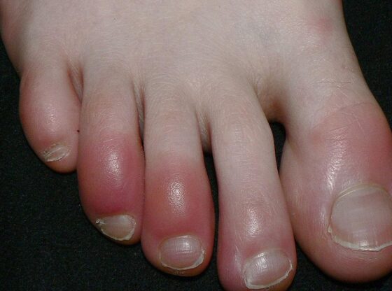 Chilblains are caused by vasoconstriction due to cold and poor circulation.